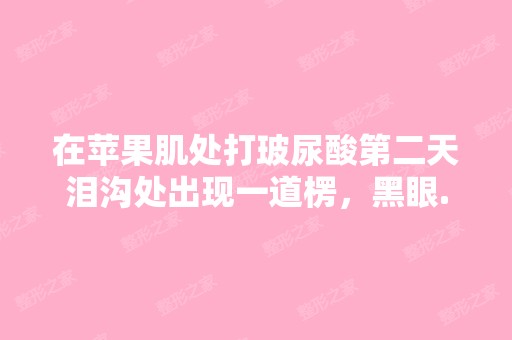 在苹果肌处打玻尿酸第二天泪沟处出现一道楞，黑眼...