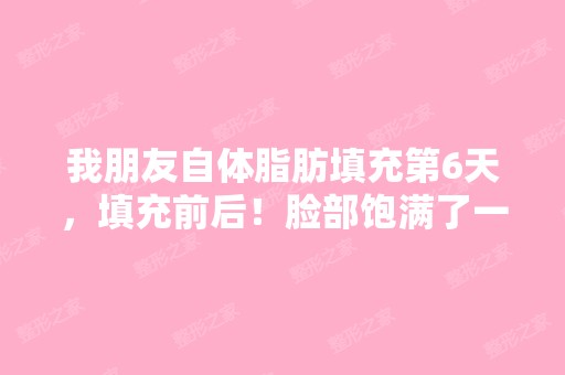 我朋友自体脂肪填充第6天，填充前后！脸部饱满了一...