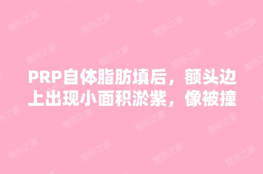 PRP自体脂肪填后，额头边上出现小面积淤紫，像被撞...