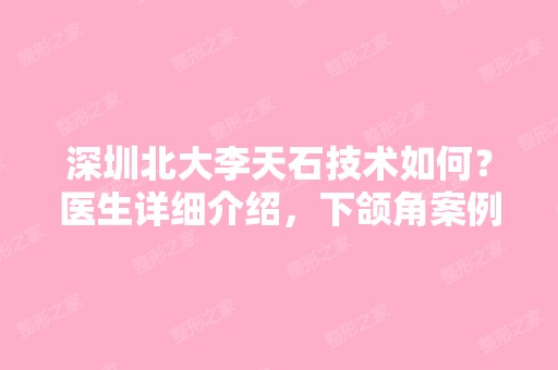 深圳北大李天石技术如何？医生详细介绍，下颌角案例展示