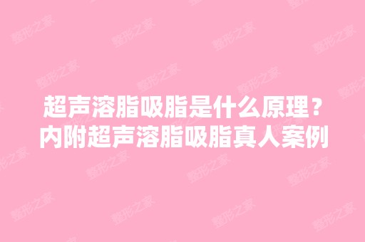 超声溶脂吸脂是什么原理？内附超声溶脂吸脂真人案例