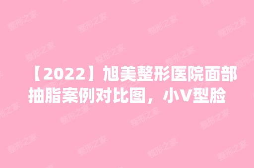 【2024】旭美整形医院面部抽脂案例对比图，小V型脸恢复经验分享_价格表参考