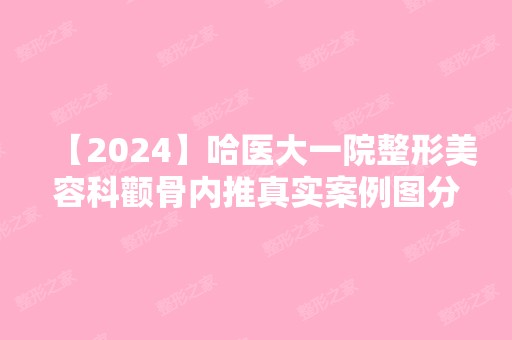 【2024】哈医大一院整形美容科颧骨内推真实案例图分享