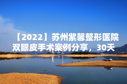 【2024】苏州紫馨整形医院双眼皮手术案例分享，30天恢复效果记录