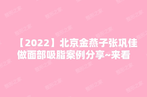 【2024】北京金燕子张巩佳做面部吸脂案例分享~来看真实案例