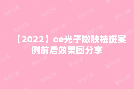 【2024】oe光子嫩肤祛斑案例前后效果图分享