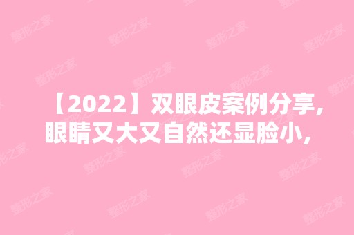 【2024】双眼皮案例分享,眼睛又大又自然还显脸小,术后效果真的很棒