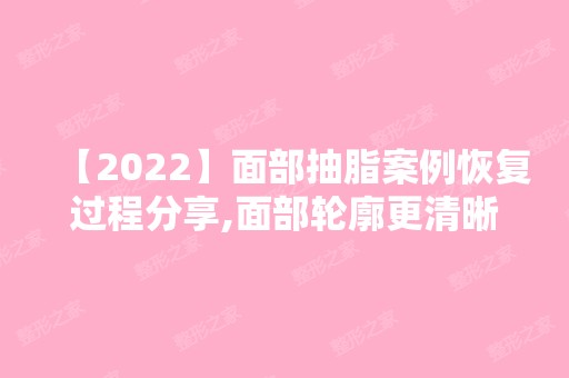 【2024】面部抽脂案例恢复过程分享,面部轮廓更清晰了