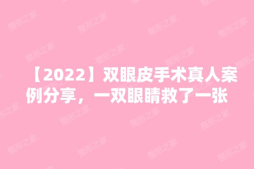 【2024】双眼皮手术真人案例分享，一双眼睛救了一张脸