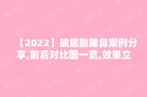 【2024】玻尿酸隆鼻案例分享,前后对比图一览,效果立马看得见