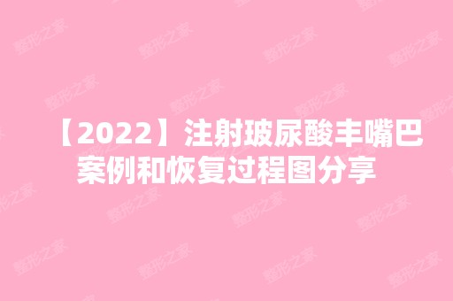 【2024】注射玻尿酸丰嘴巴案例和恢复过程图分享