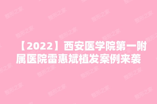 【2024】西安医学院第一附属医院雷惠斌植发案例来袭~来看详细介绍