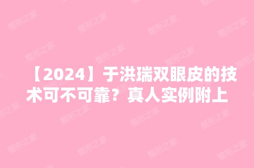 【2024】于洪瑞双眼皮的技术可不可靠？真人实例附上