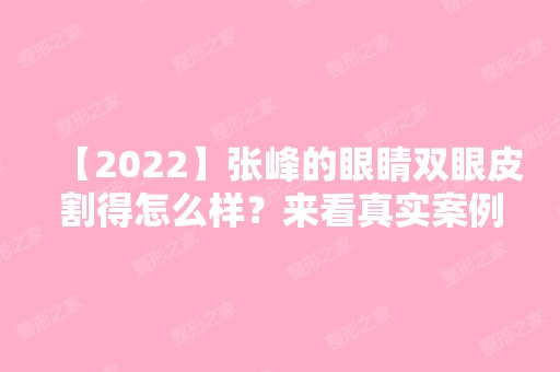 【2024】张峰的眼睛双眼皮割得怎么样？来看真实案例图