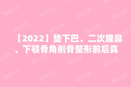 【2024】垫下巴、二次隆鼻、下颚骨角削骨整形前后真实案例对比图及价格表