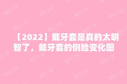 【2024】戴牙套是真的太明智了，戴牙套的侧脸变化图分享