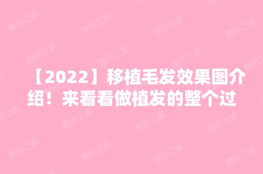 【2024】移植毛发效果图介绍！来看看做植发的整个过程图吧