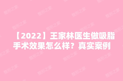 【2024】王家林医生做吸脂手术效果怎么样？真实案例及对比图分享~