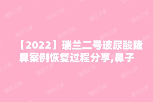 【2024】瑞兰二号玻尿酸隆鼻案例恢复过程分享,鼻子高挺自然,恢复还快