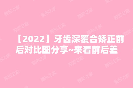 【2024】牙齿深覆合矫正前后对比图分享~来看前后差别大不大