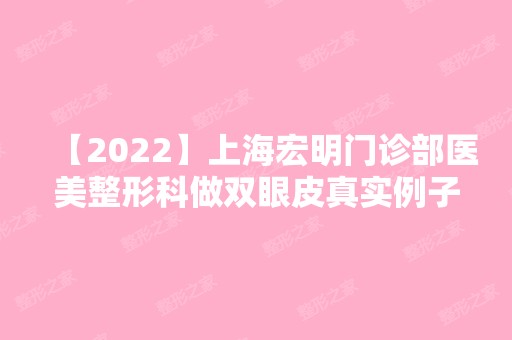 【2024】上海宏明门诊部医美整形科做双眼皮真实例子分享