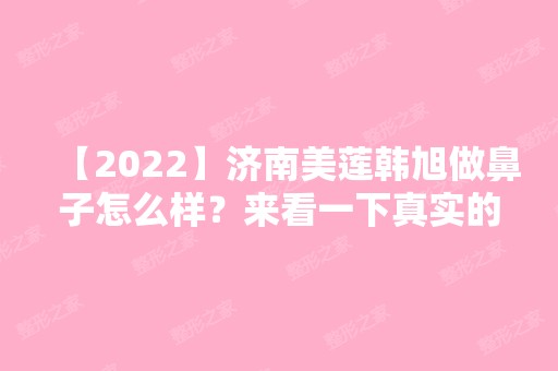 【2024】济南美莲韩旭做鼻子怎么样？来看一下真实的隆鼻案例