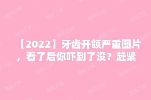 【2024】牙齿开颌严重图片，看了后你吓到了没？赶紧来了解矫正方法吧。