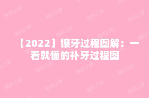 【2024】镶牙过程图解：一看就懂的补牙过程图