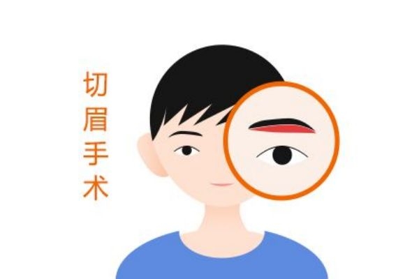 切眉有什么作用 为什么要切眉 